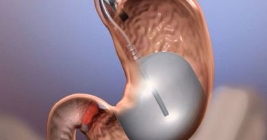 Palloncino gastrico in farmacia